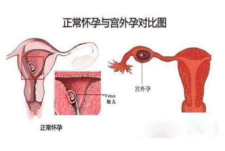 试管移植会导致宫外孕吗？