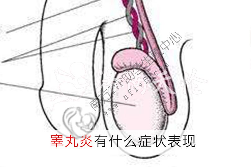 正规三代试管婴儿费用:睾丸炎的症状是什么？