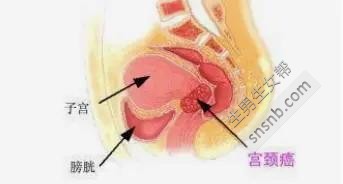 女性不孕的原因有哪些？导致不孕不育的5大原因